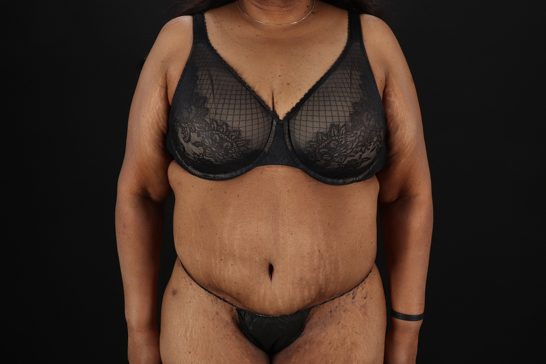 Cosmetic Body Lift Before & After Patient #9761
