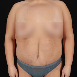 Cosmetic Body Lift Before & After Patient #9766