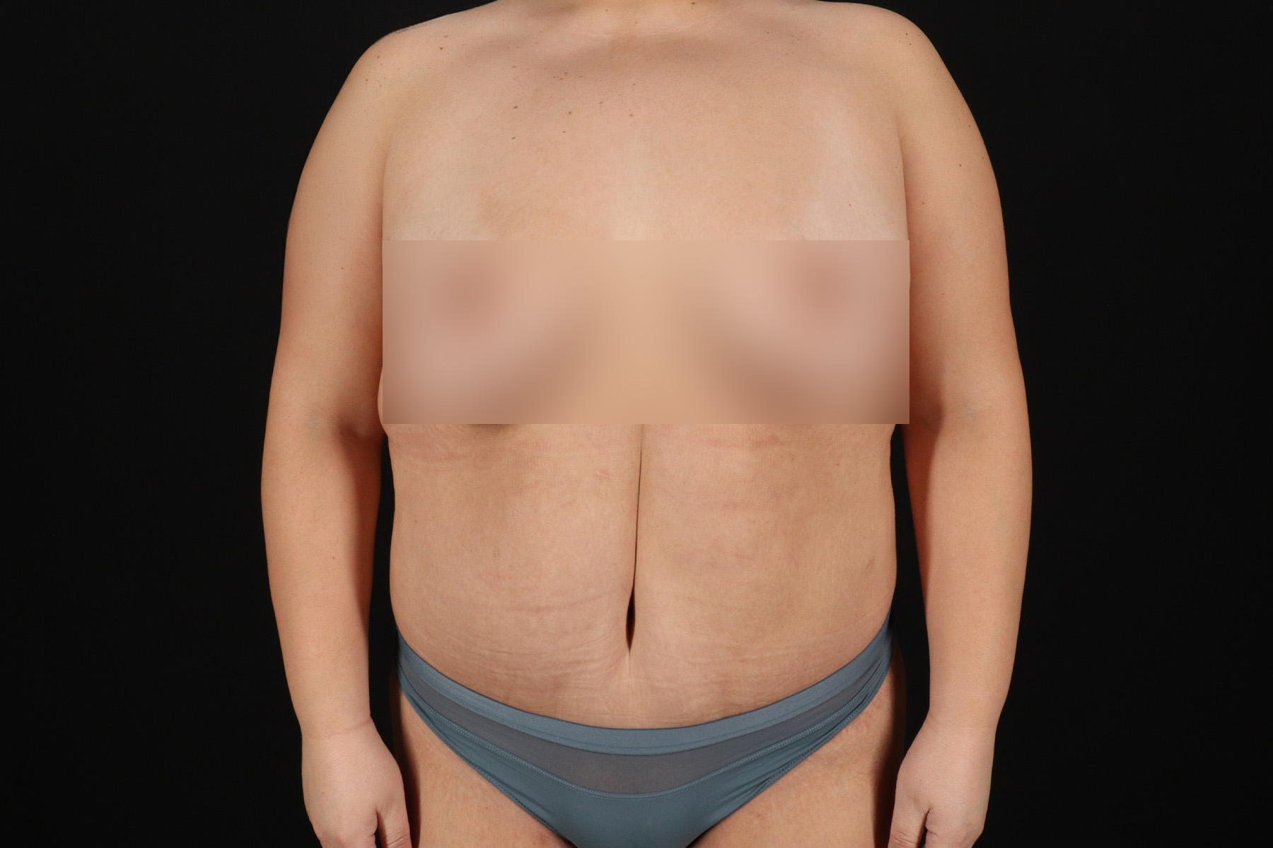 Cosmetic Body Lift Before & After Patient #9766
