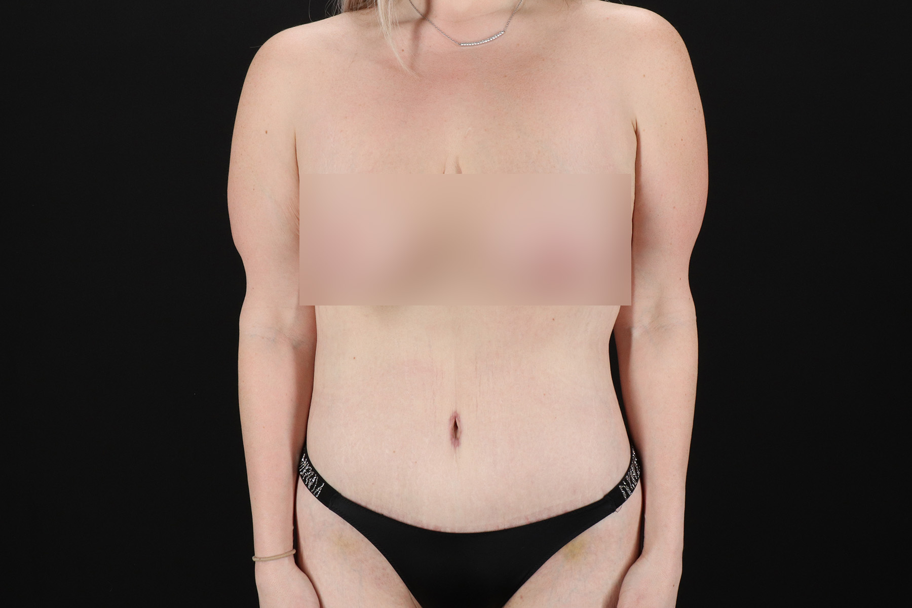 Cosmetic Body Lift Before & After Patient #9768