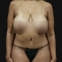 Cosmetic Body Lift Before & After Patient #9758