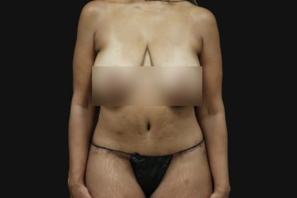 Cosmetic Body Lift Before & After Patient #9758