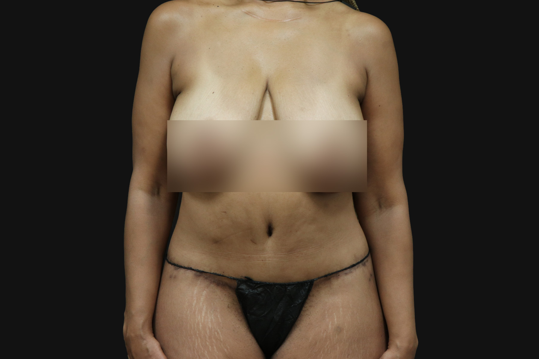 Cosmetic Body Lift Before & After Patient #9758