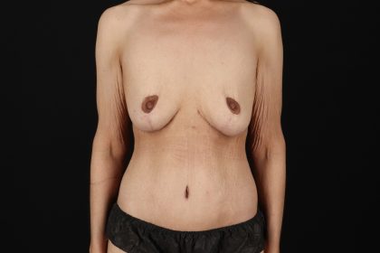 Cosmetic Body Lift Before & After Patient #9756