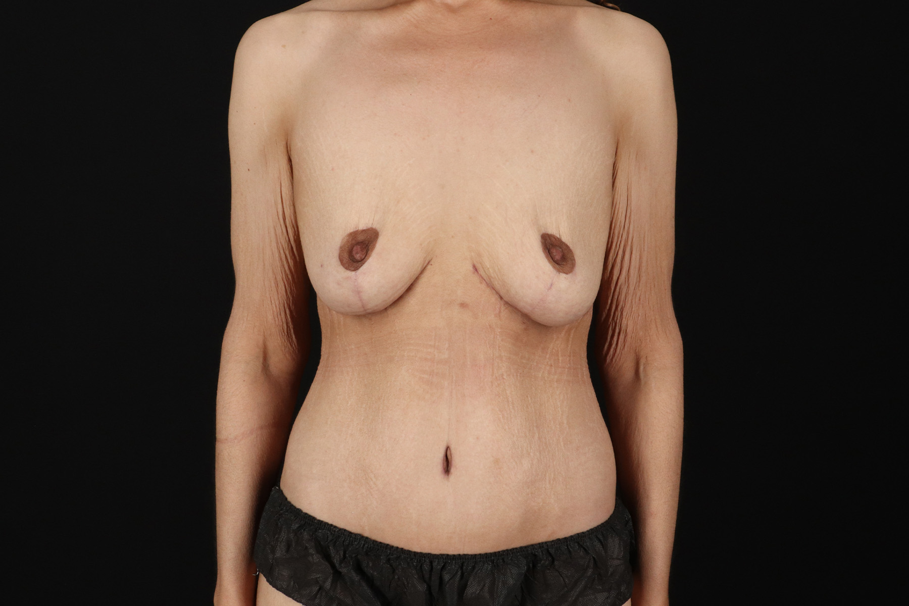 Cosmetic Body Lift Before & After Patient #9756