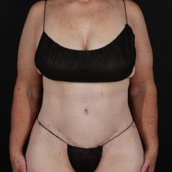 Cosmetic Body Lift Before & After Patient #9757