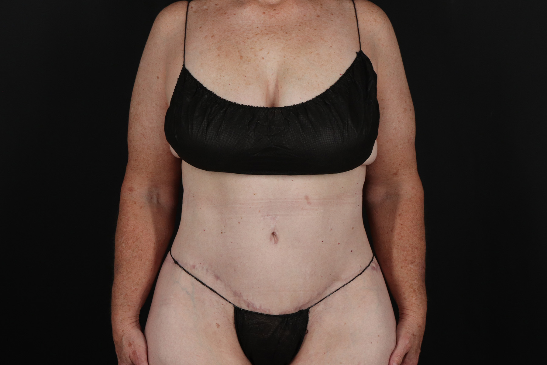 Cosmetic Body Lift Before & After Patient #9757
