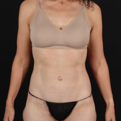 Cosmetic Body Lift Before & After Patient #9760