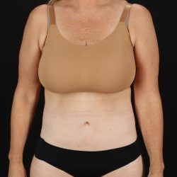 Cosmetic Body Lift Before & After Patient #9767