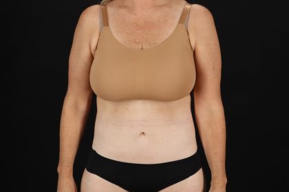 Cosmetic Body Lift Before & After Patient #9767