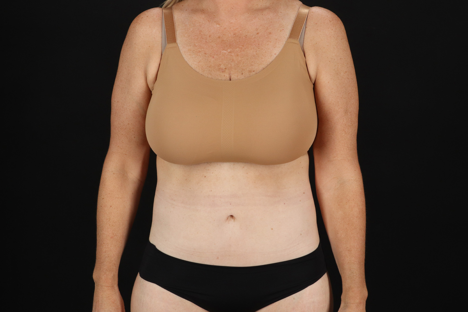 Cosmetic Body Lift Before & After Patient #9767