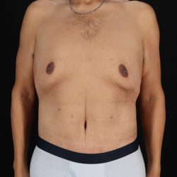 Cosmetic Body Lift Before & After Patient #9764