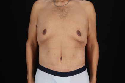 Cosmetic Body Lift Before & After Patient #9764