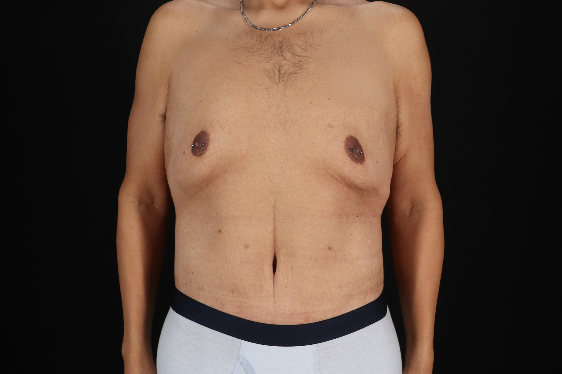 Cosmetic Body Lift Before & After Patient #9764