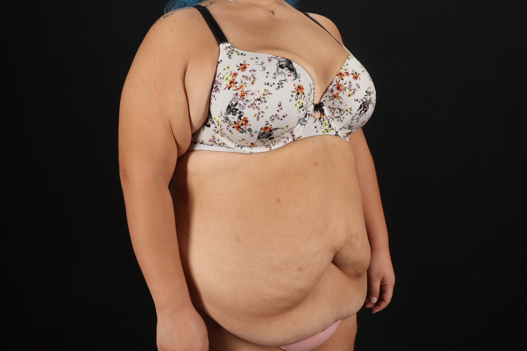 Cosmetic Body Lift Before & After Patient #9766