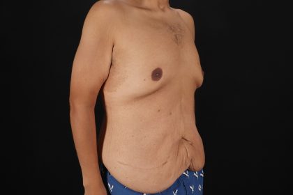 Cosmetic Body Lift Before & After Patient #9764