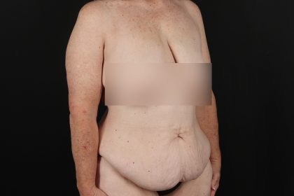 Cosmetic Body Lift Before & After Patient #9757