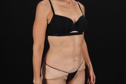 Cosmetic Body Lift Before & After Patient #9760