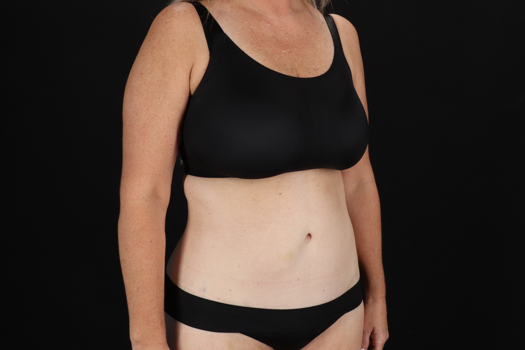 Cosmetic Body Lift Before & After Patient #9767