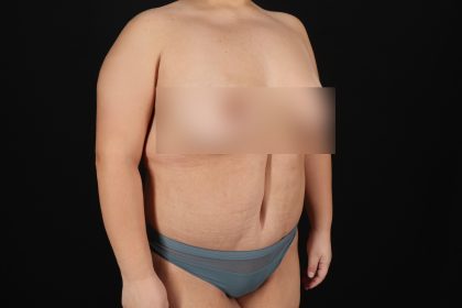 Cosmetic Body Lift Before & After Patient #9766