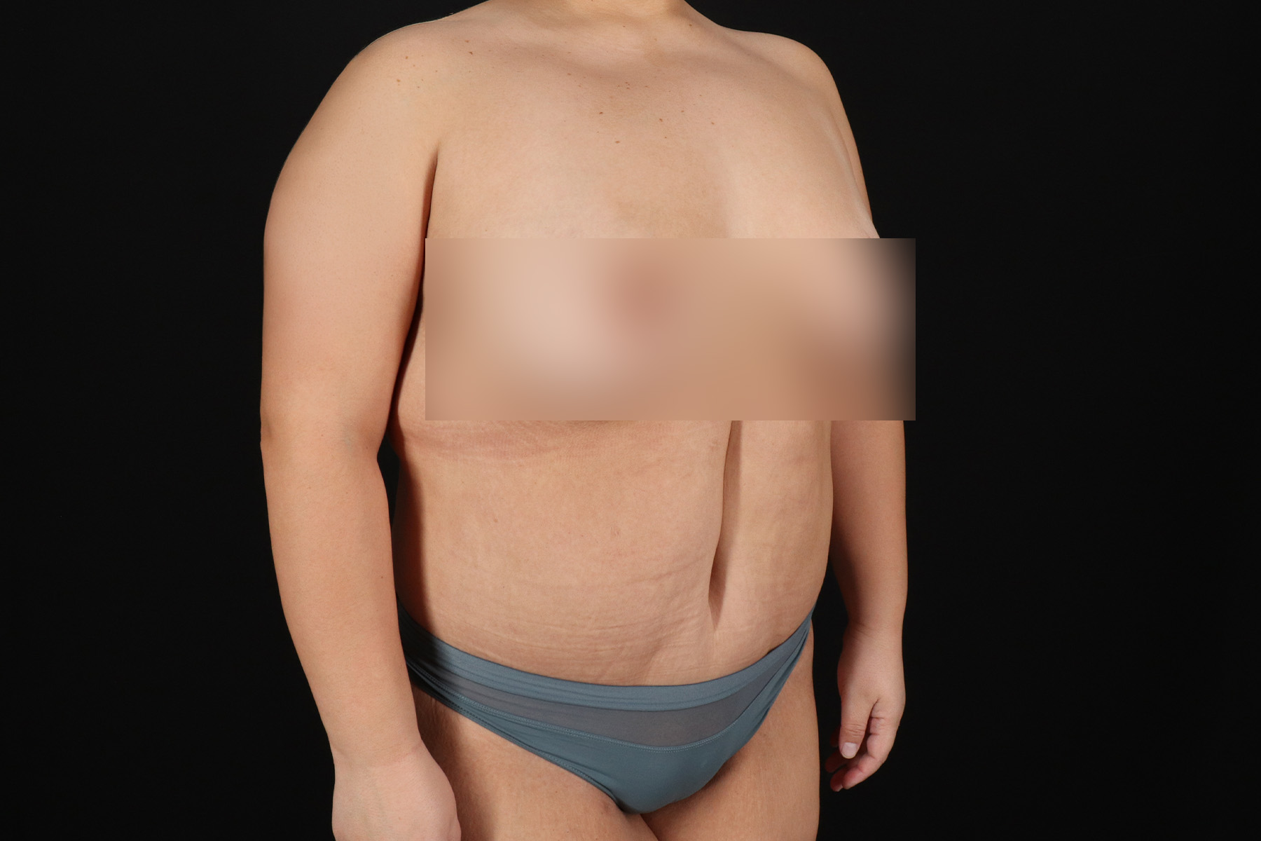 Cosmetic Body Lift Before & After Patient #9766