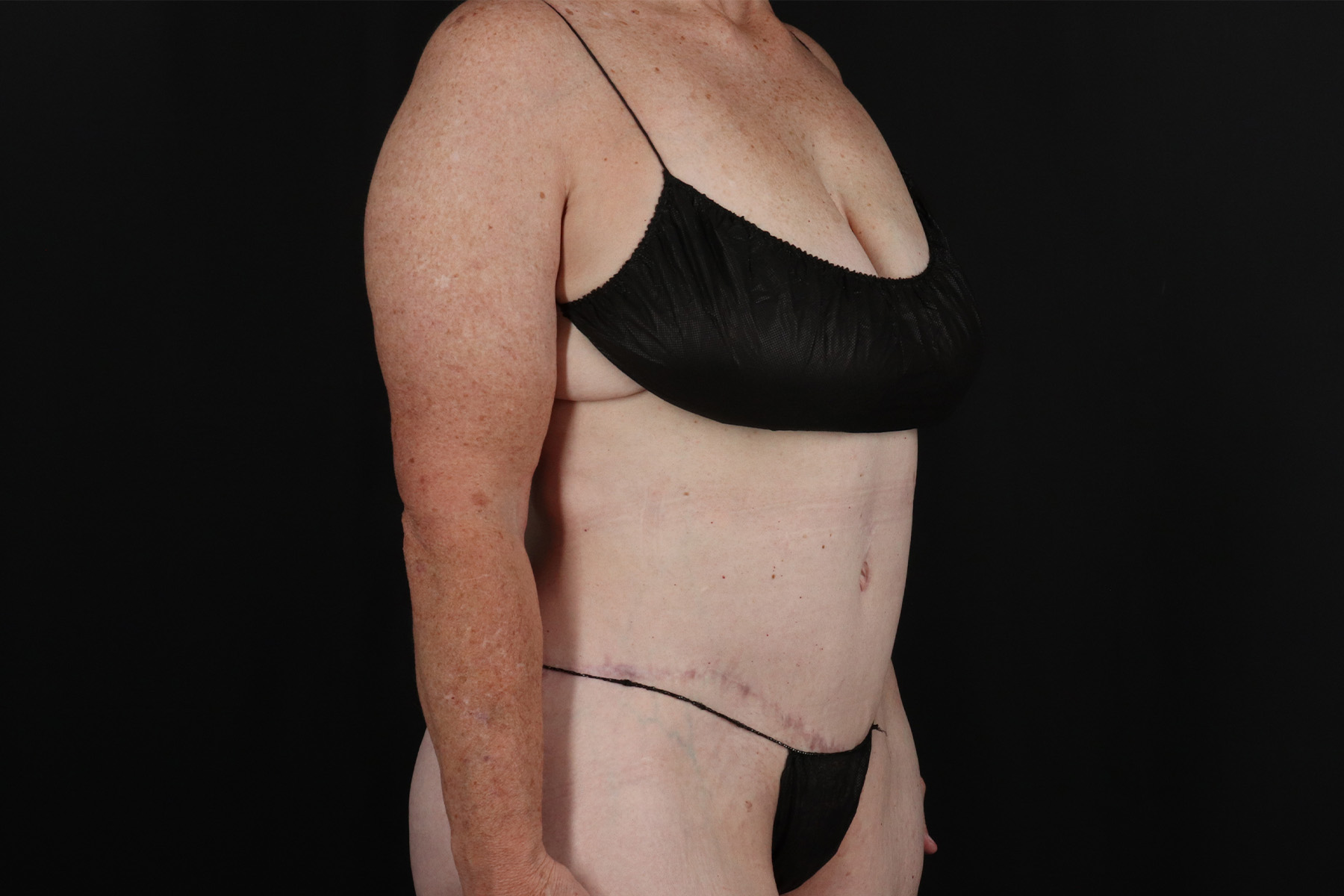 Cosmetic Body Lift Before & After Patient #9757
