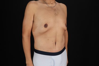 Cosmetic Body Lift Before & After Patient #9764