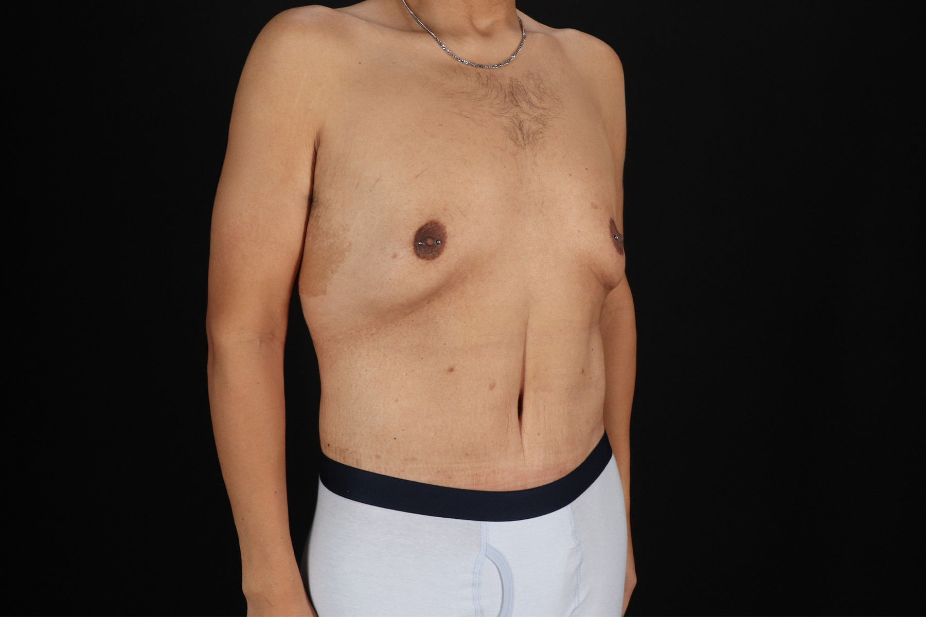 Cosmetic Body Lift Before & After Patient #9764