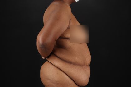 Cosmetic Body Lift Before & After Patient #9761