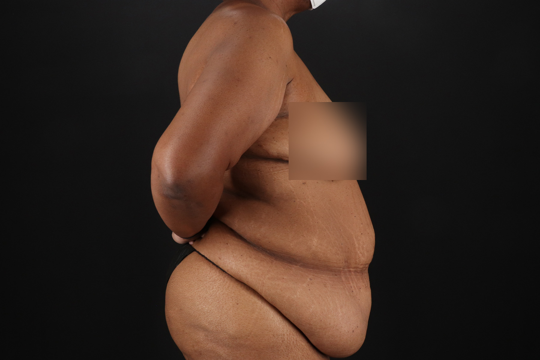 Cosmetic Body Lift Before & After Patient #9761