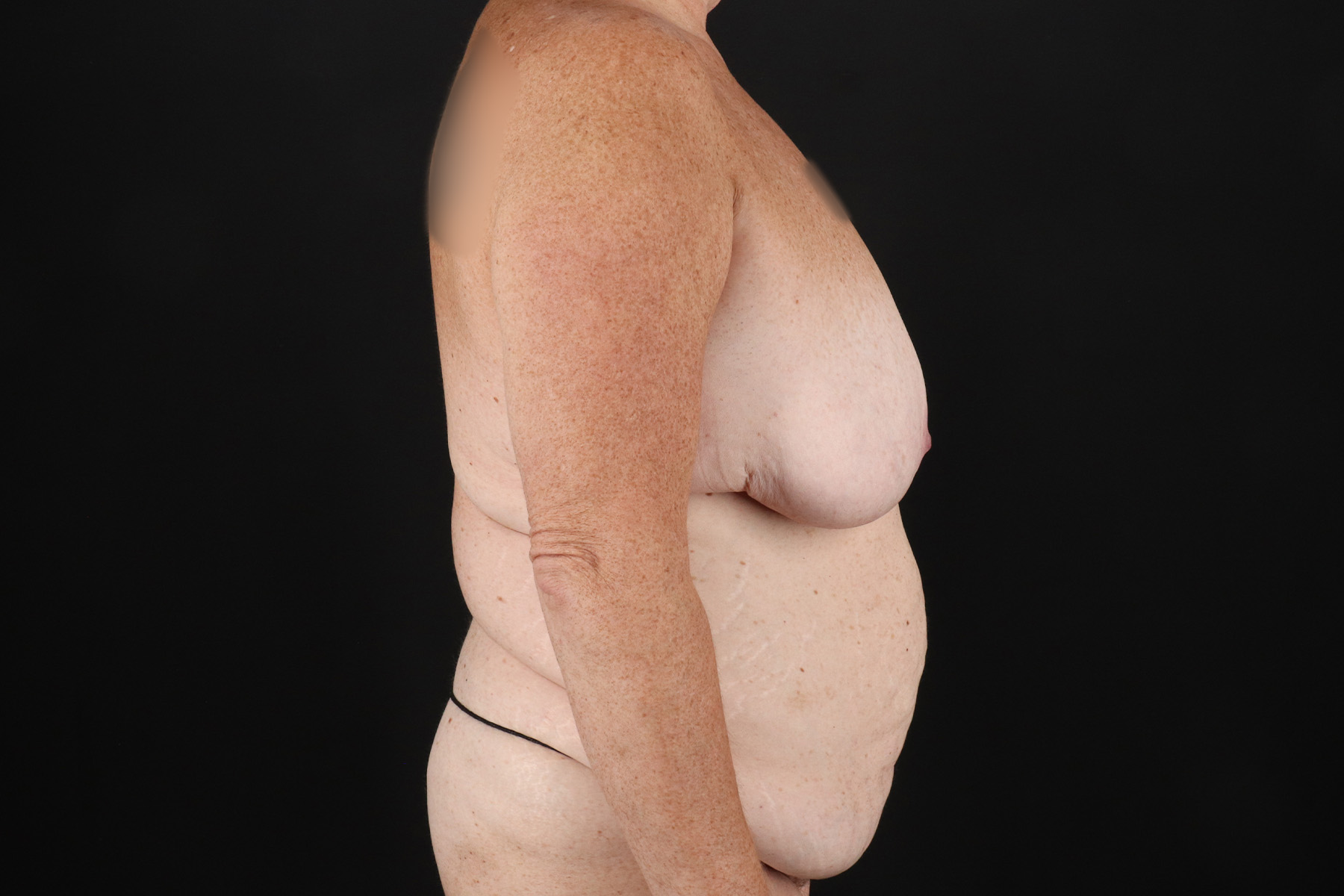 Cosmetic Body Lift Before & After Patient #9763