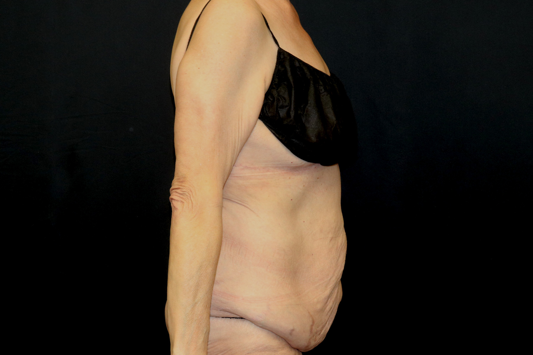 Cosmetic Body Lift Before & After Patient #9762