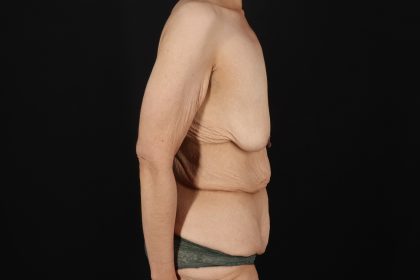 Cosmetic Body Lift Before & After Patient #9756