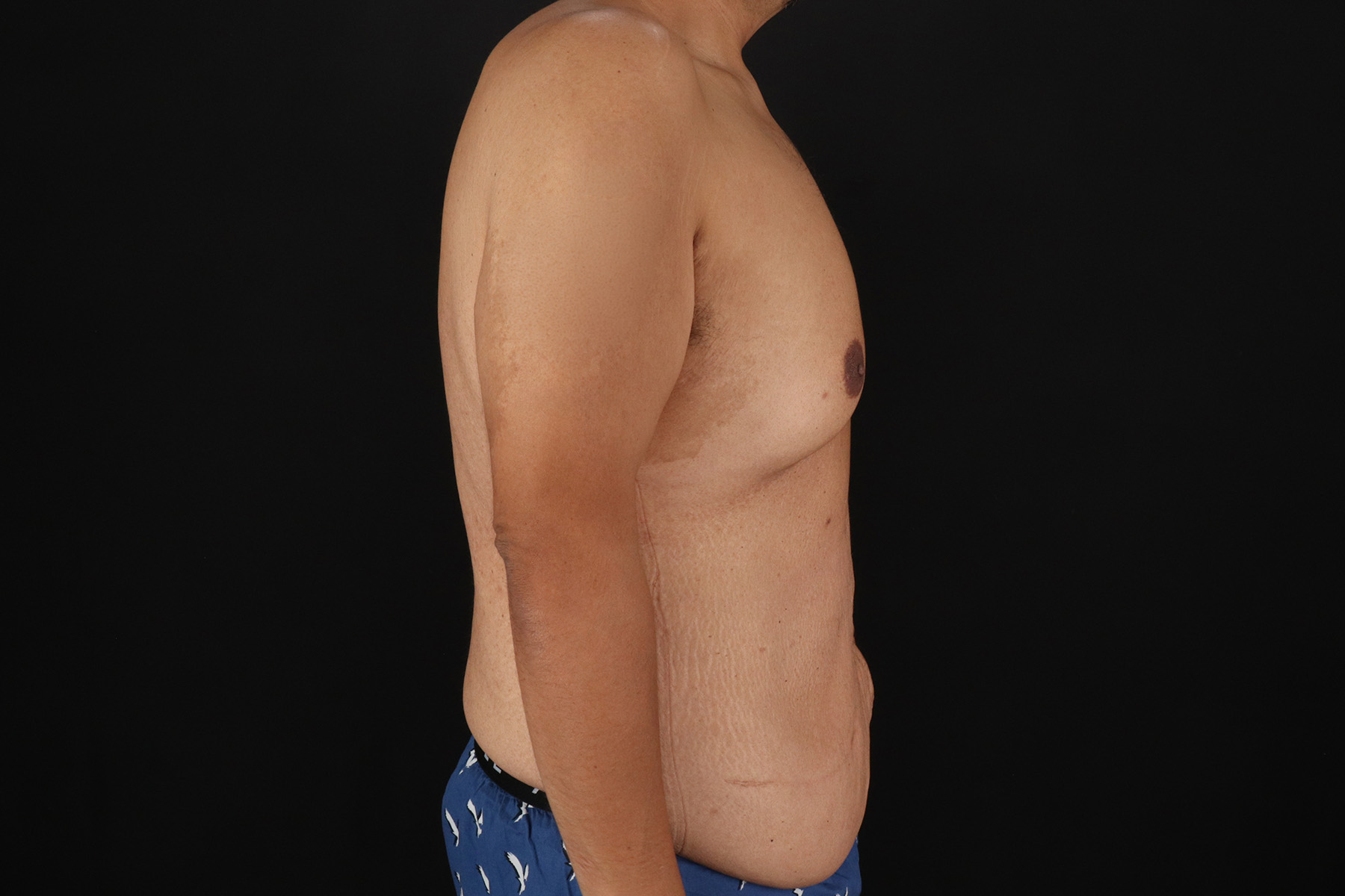 Cosmetic Body Lift Before & After Patient #9764