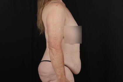 Cosmetic Body Lift Before & After Patient #9757