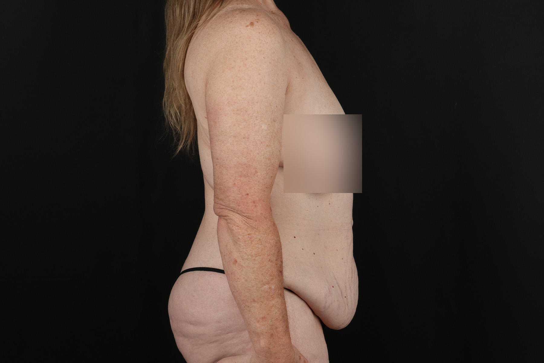 Cosmetic Body Lift Before & After Patient #9757