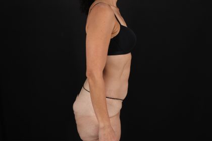 Cosmetic Body Lift Before & After Patient #9760