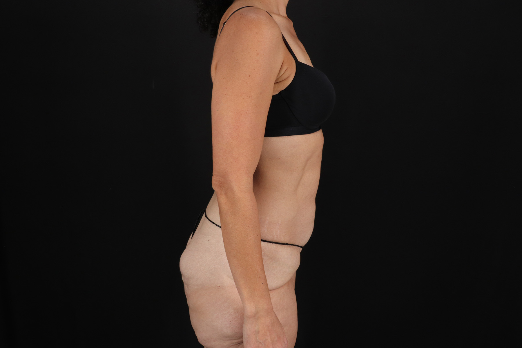 Cosmetic Body Lift Before & After Patient #9760