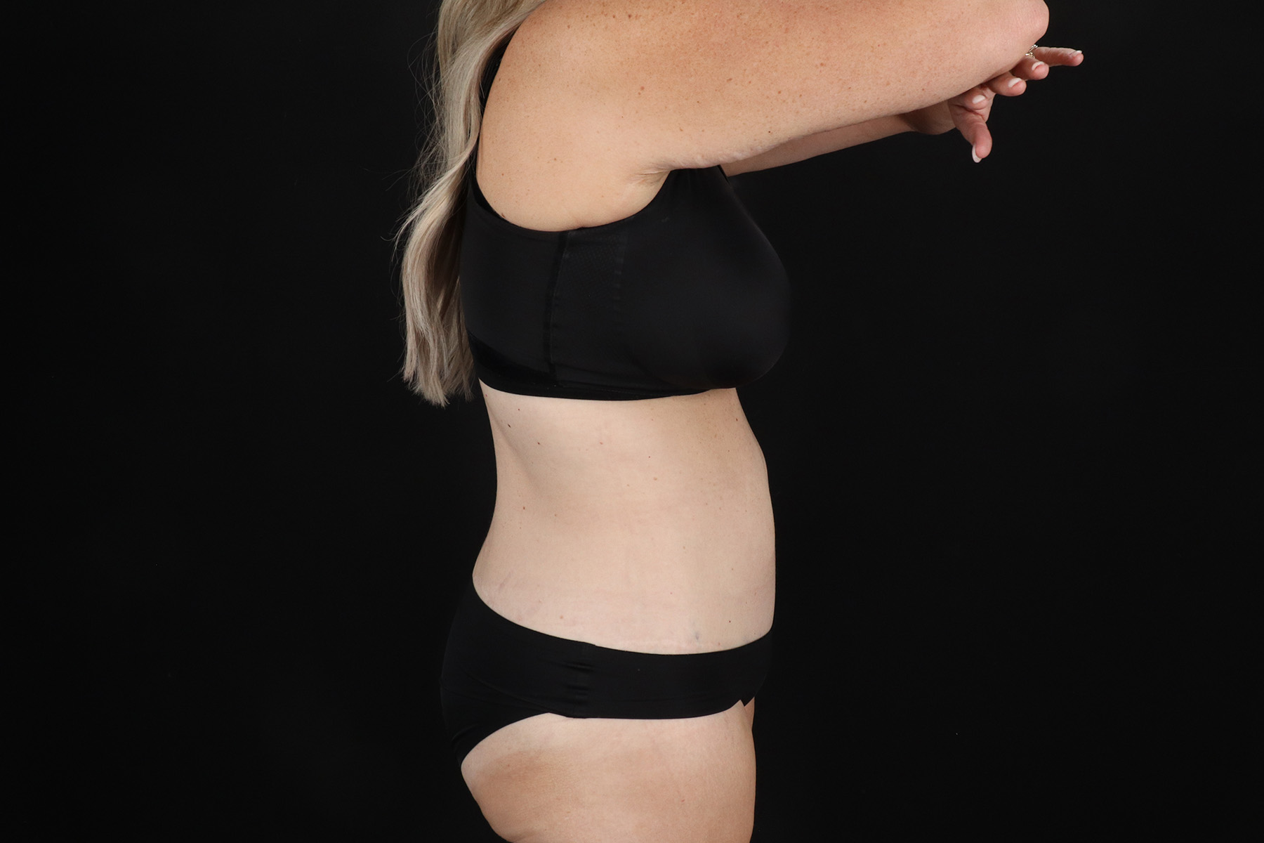 Cosmetic Body Lift Before & After Patient #9767