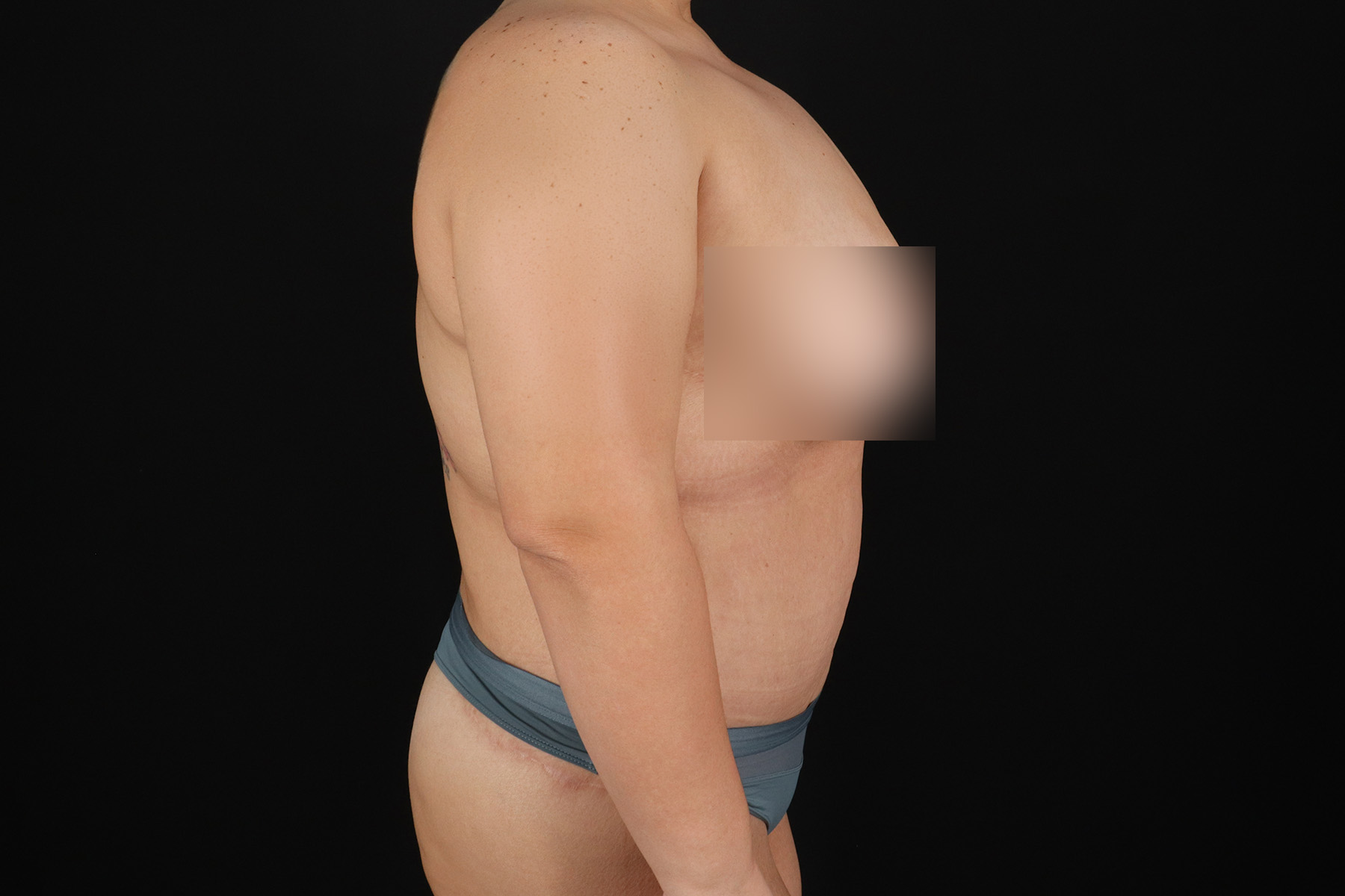 Cosmetic Body Lift Before & After Patient #9766
