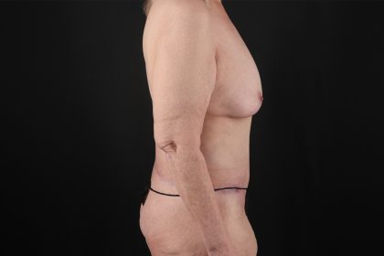 Cosmetic Body Lift Before & After Patient #9771
