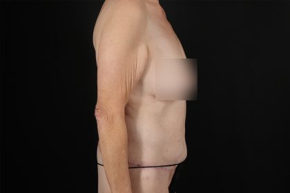 Cosmetic Body Lift Before & After Patient #9762