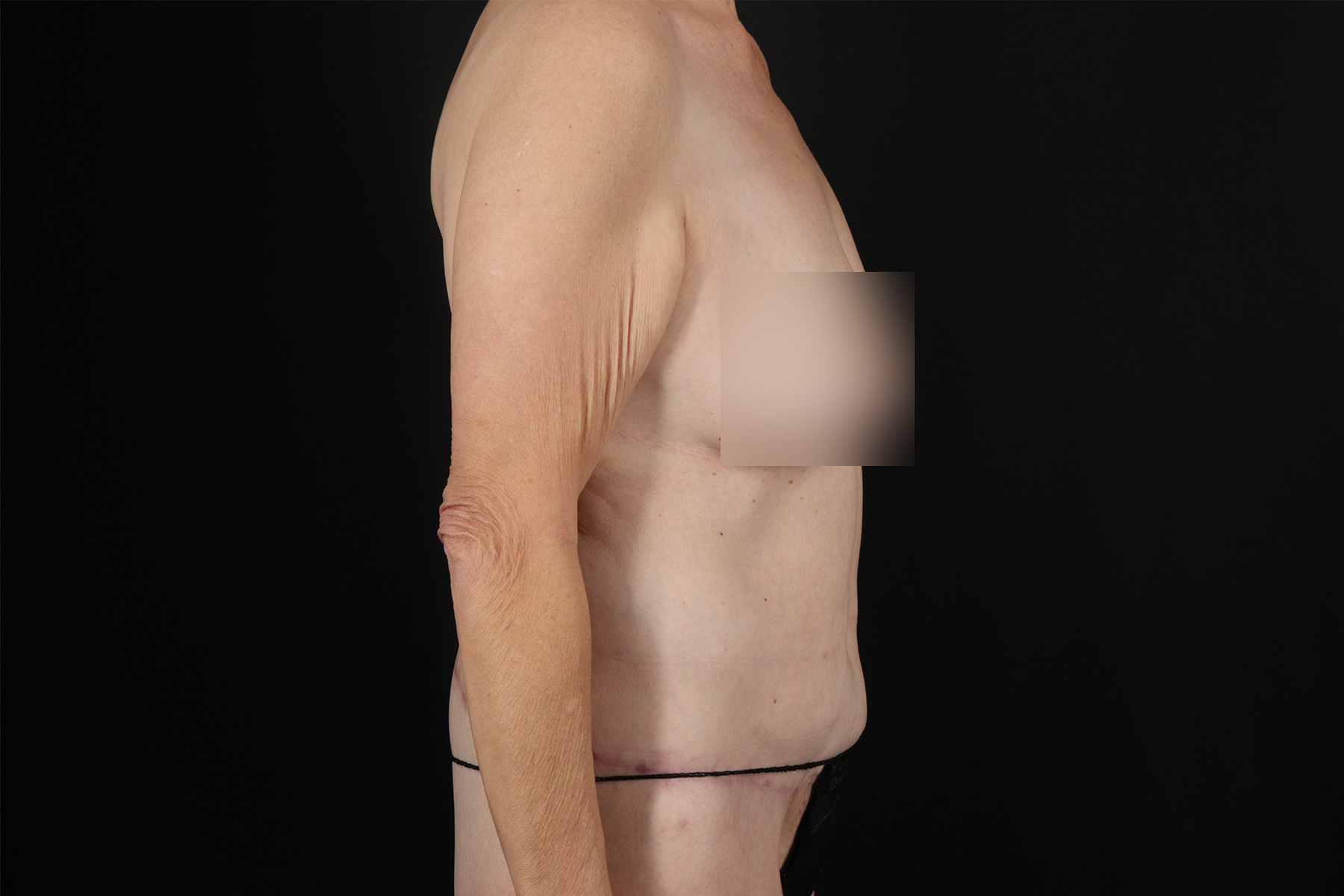 Cosmetic Body Lift Before & After Patient #9762