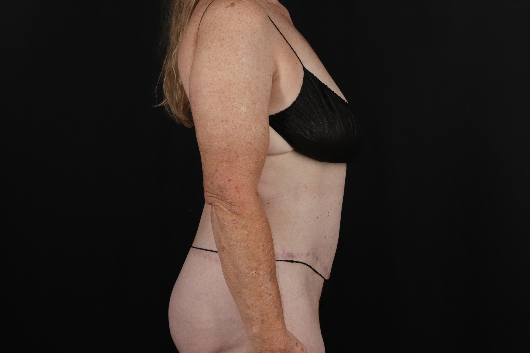 Cosmetic Body Lift Before & After Patient #9757