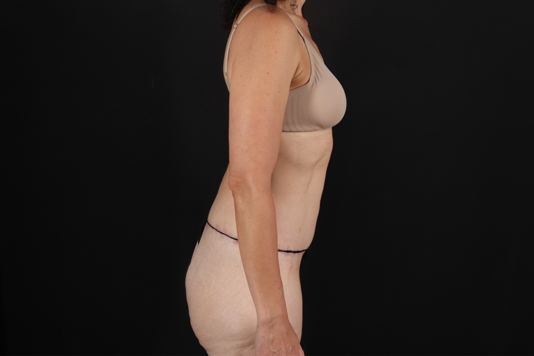 Cosmetic Body Lift Before & After Patient #9760