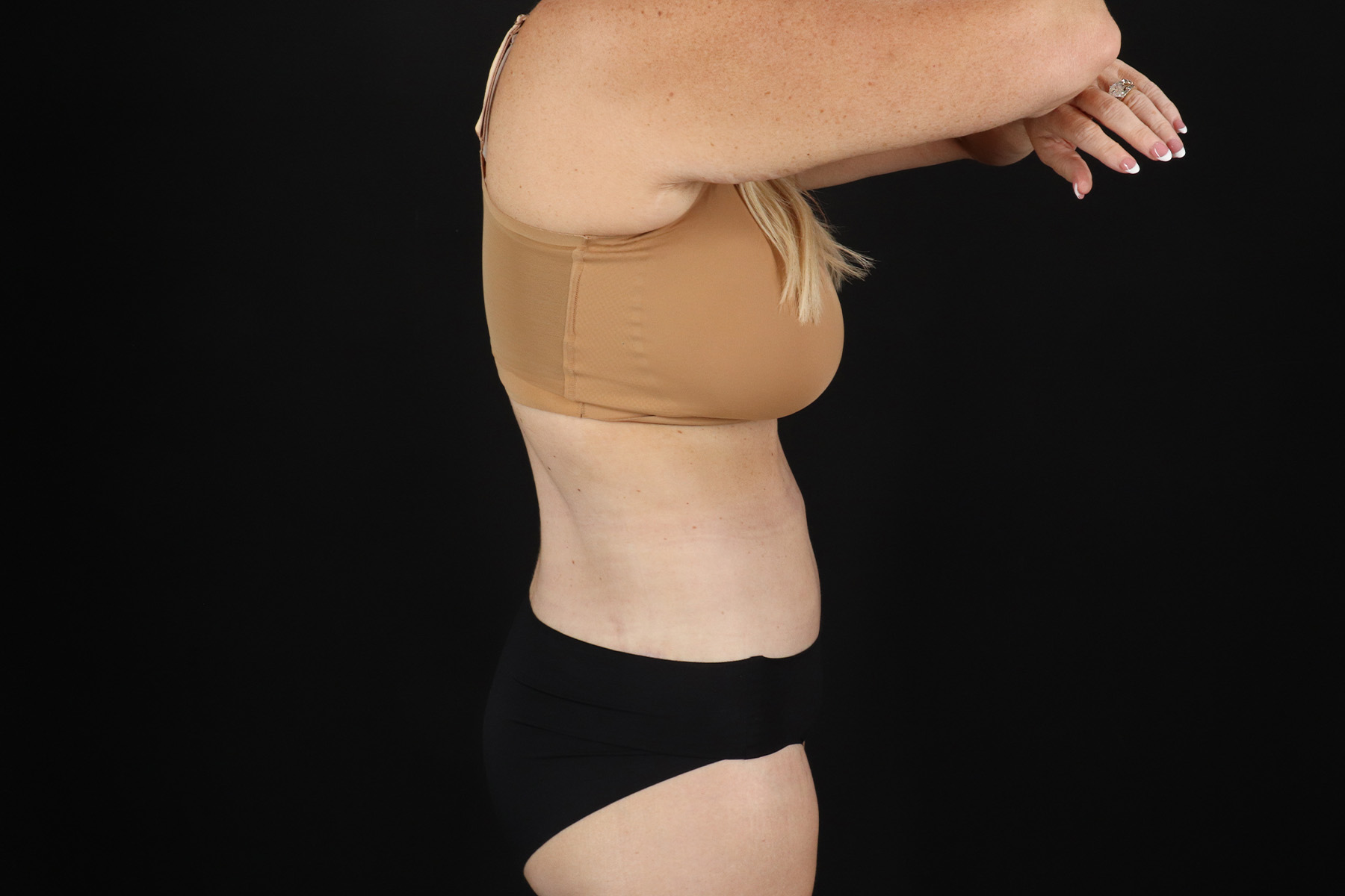 Cosmetic Body Lift Before & After Patient #9767