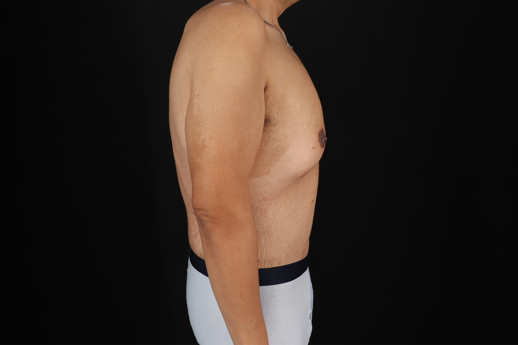 Cosmetic Body Lift Before & After Patient #9764