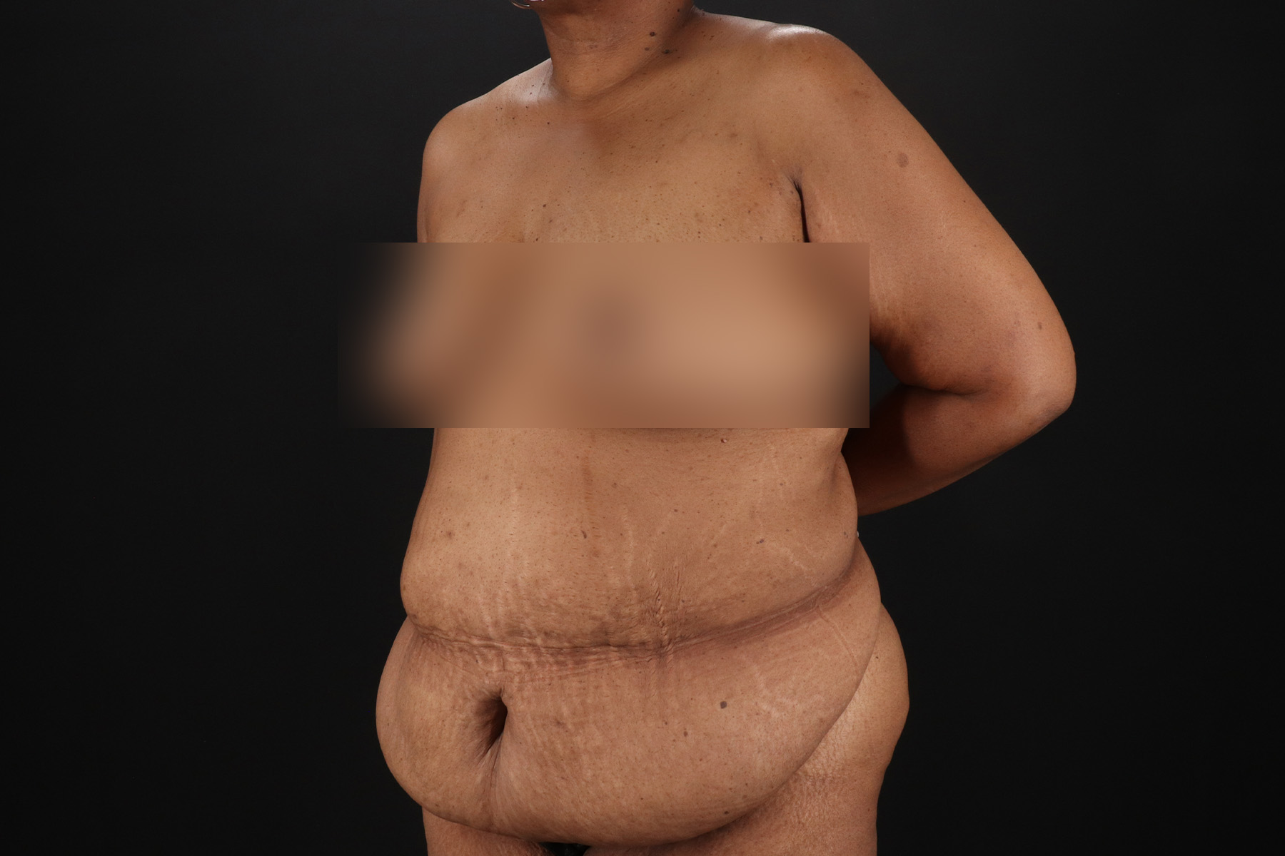 Cosmetic Body Lift Before & After Patient #9761