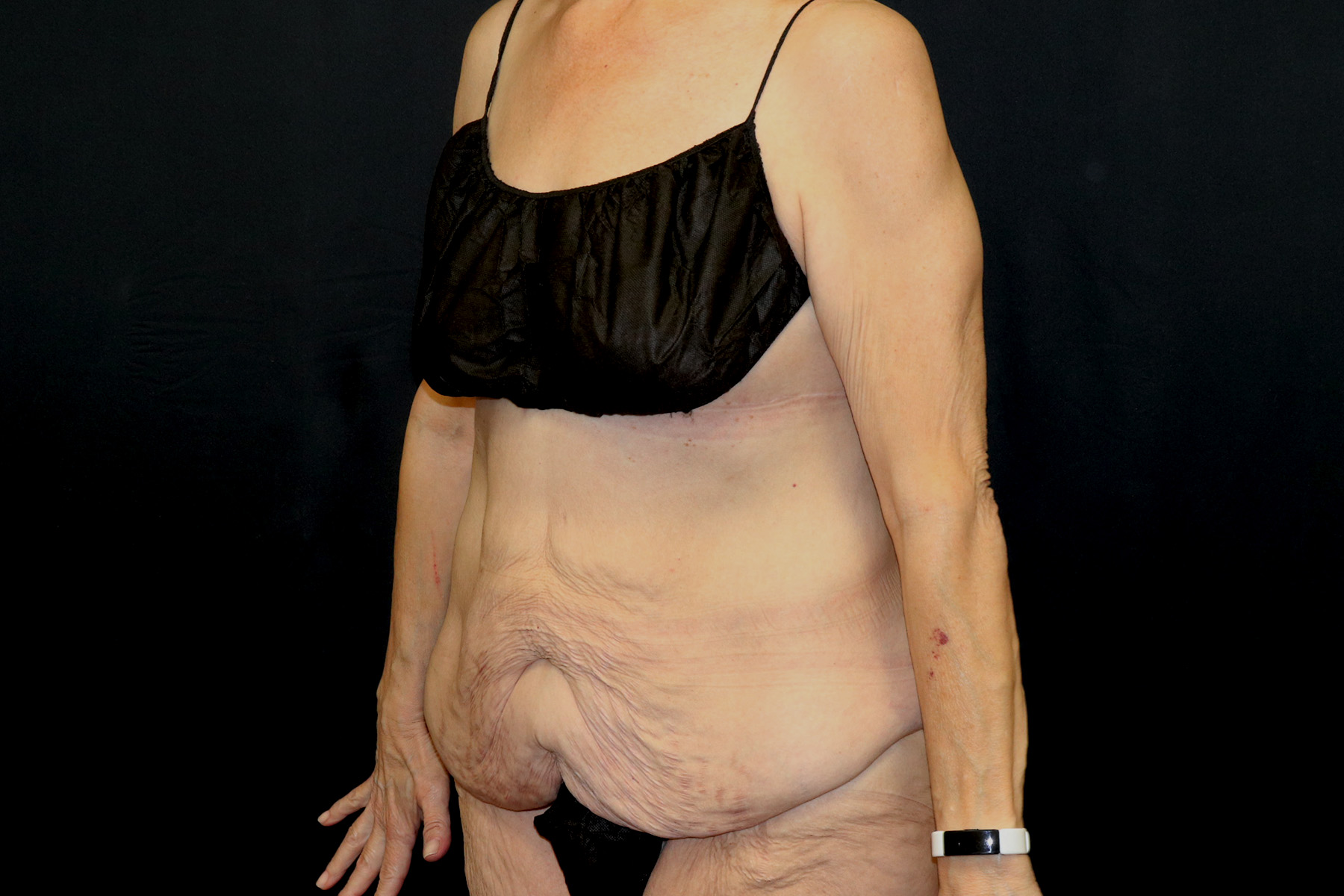Cosmetic Body Lift Before & After Patient #9762