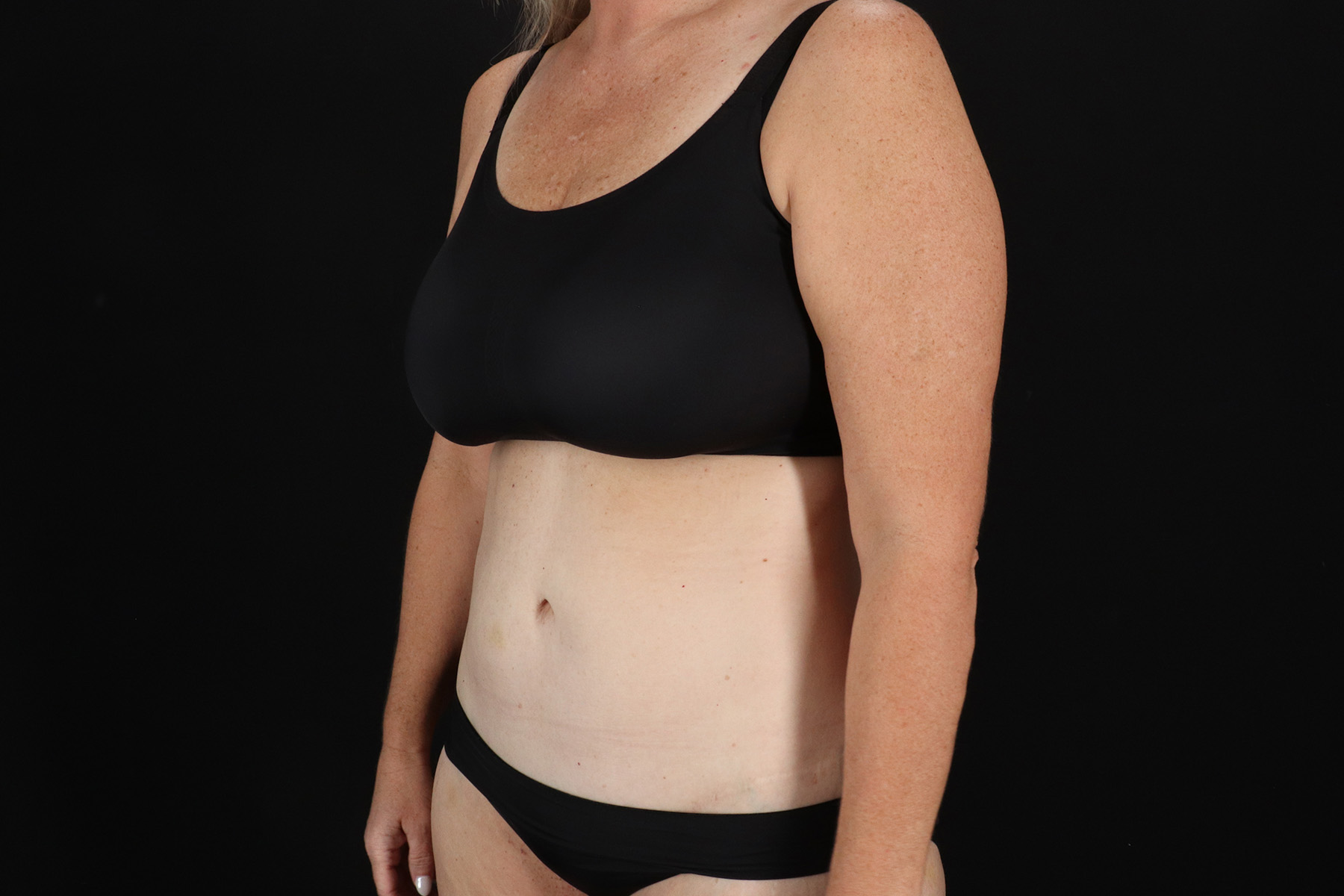 Cosmetic Body Lift Before & After Patient #9767